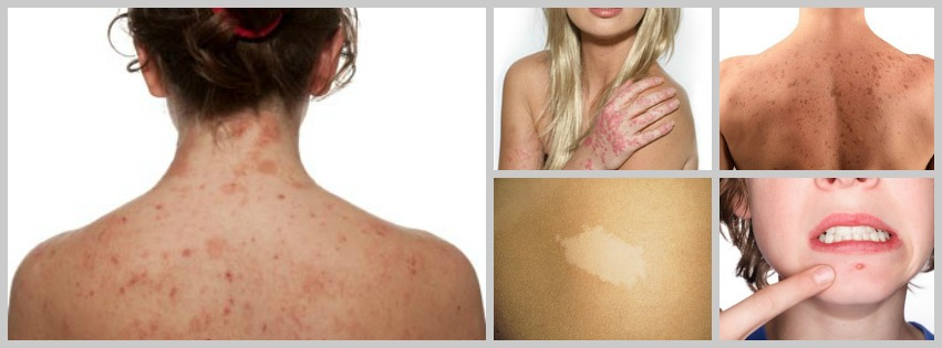 Eczema Treatment Raleigh Nc